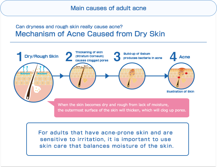 Main causes of adult acne | Can dryness and rough skin really cause acne? Mechanism of Acne Caused from Dry Skin | 1. Dry/Rough Skin 2. Thickening of skin (Stratum Corneum) causes clogged pores 3. Build-up of Sebum produces bacteria in acne 4. Acne | When the skin becomes dry and rough from lack of moisture,the outermost surface of the skin will thicken, which will clog up pores.For adults that have acne-prone skin and are sensitive to irritation, it is important to use skin care that balances moisture of the skin.