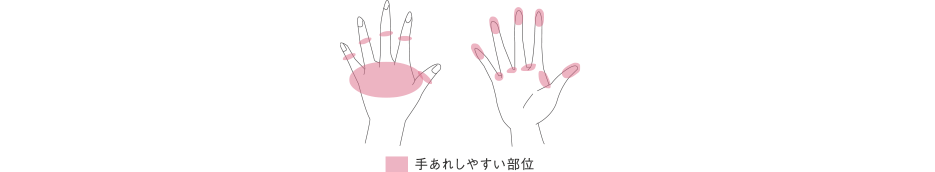 手あれしやすい部位を示した手のイラスト。指の関節、手の甲、指先、指と指の間など