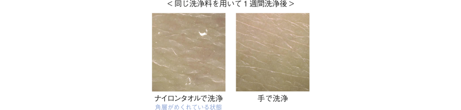 同じ洗浄料を用いて１週間洗浄した後の写真。１枚目はナイロンタオルで洗浄し角層がめくれている状態の写真。２枚目は手で洗浄した写真