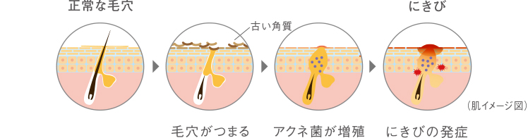 にきびができる仕組み（�@正常な毛穴、�A古い角質で毛穴がつまる、�Bアクネ菌が増殖、�Cにきびの発症）を示す肌イメージ図