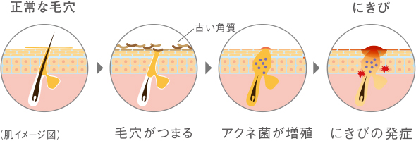 にきびができる仕組み（�@正常な毛穴、�A古い角質で毛穴がつまる、�Bアクネ菌が増殖、�Cにきびの発症）を示す肌イメージ図