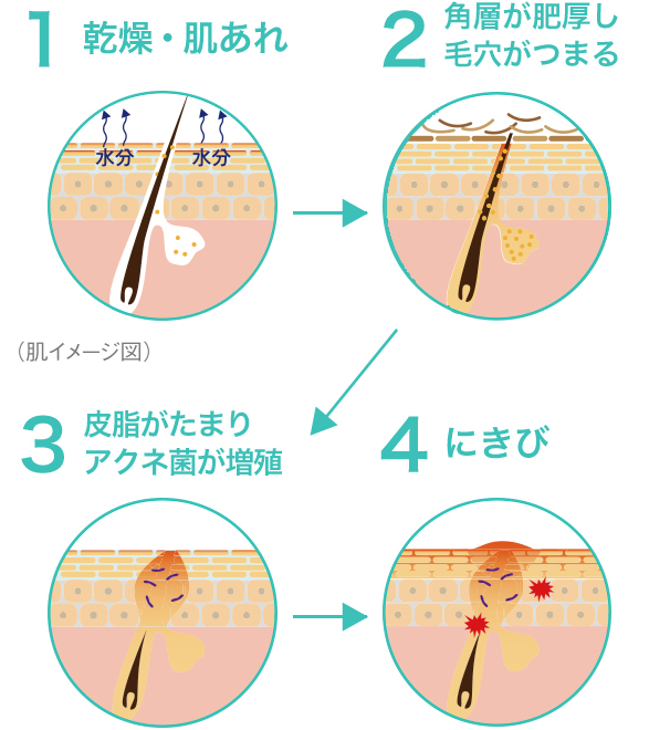 販売 乳液はアクネ菌の栄養になる